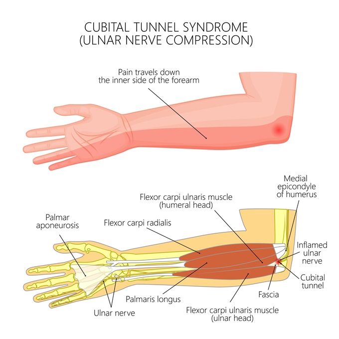 Ảnh 2 của Cubital Tunnel Syndrome